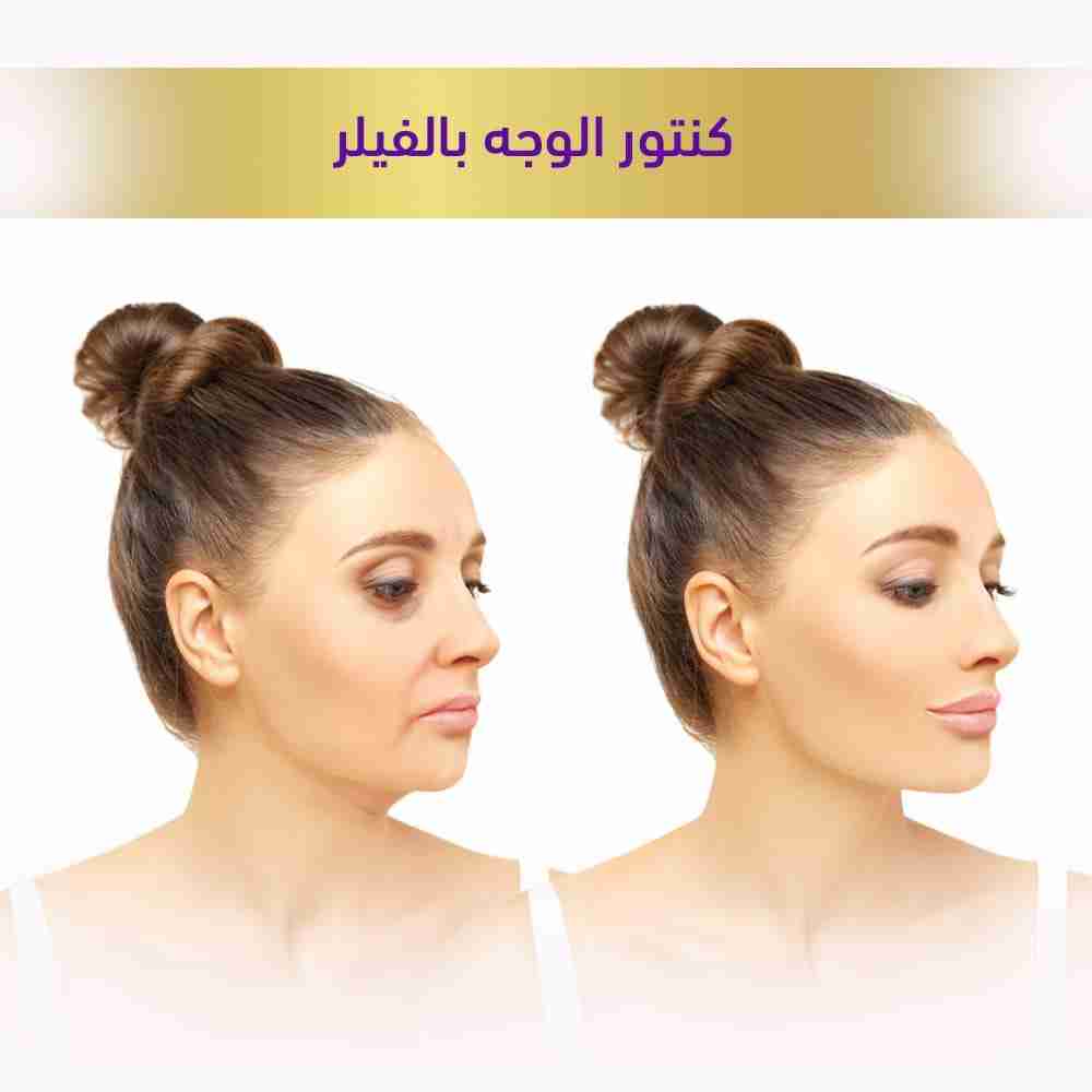 كنتور الوجه بالفيلر