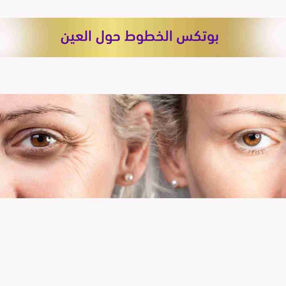 بوتكس الخطوط حول العينين