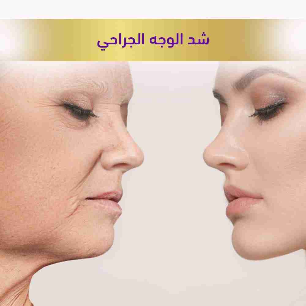 شد الوجه الجراحي