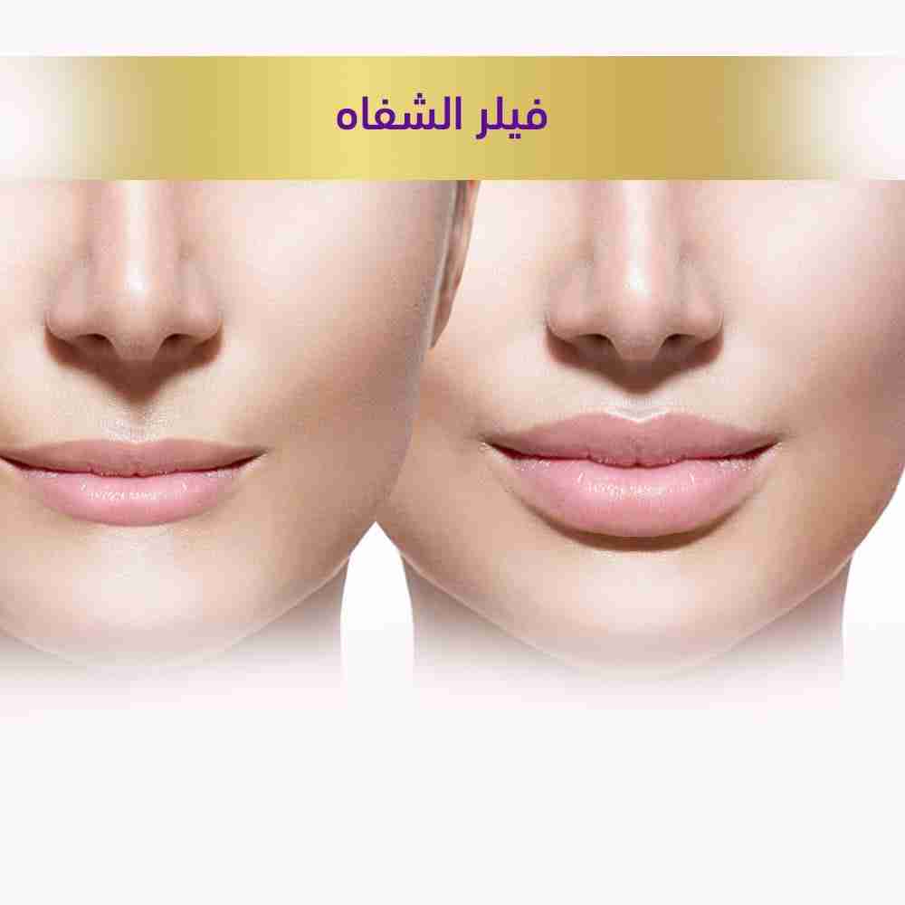 فيلر الشفاه
