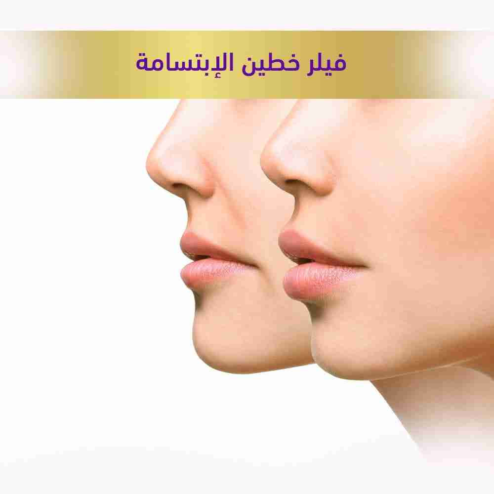 فيلر خطين الإبتسامه