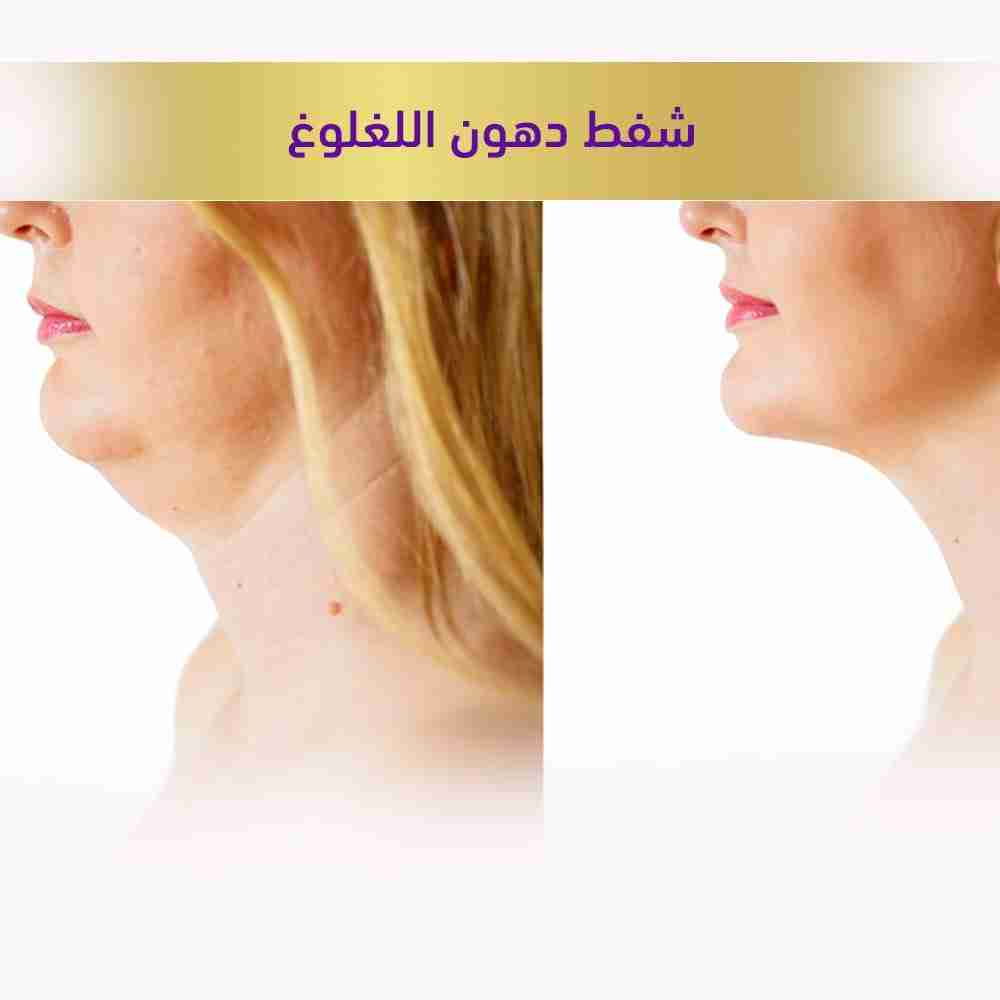 شفط دهون اللغلوغ