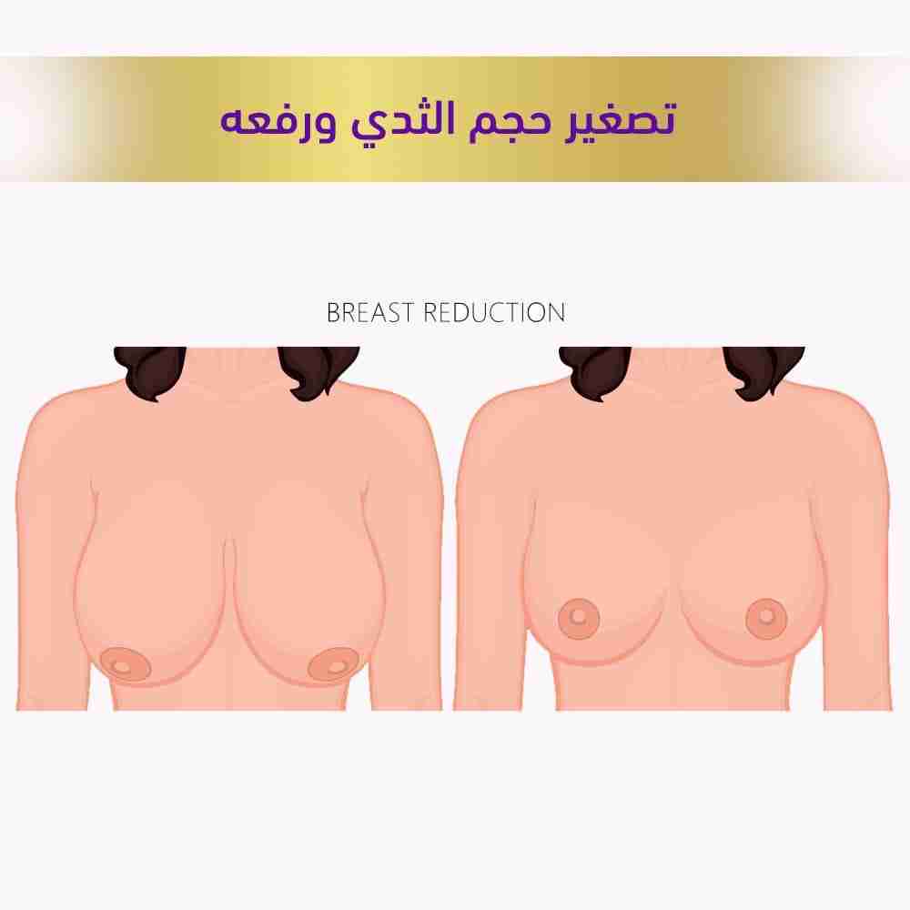 تصغير حجم الثدي ورفعه