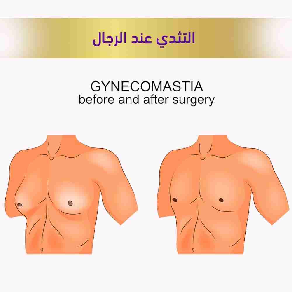 التثدي عند الرجال