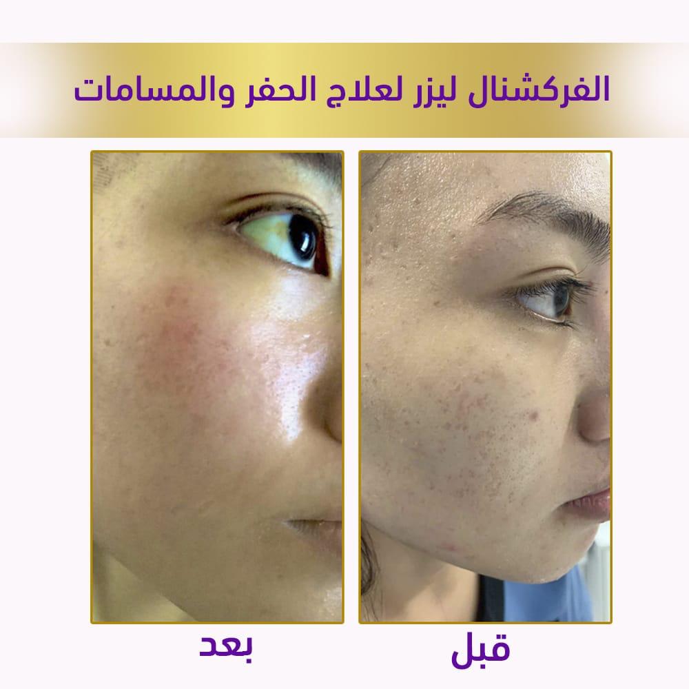 الفركشنال ليزر لعلاج الحفر والمسامات