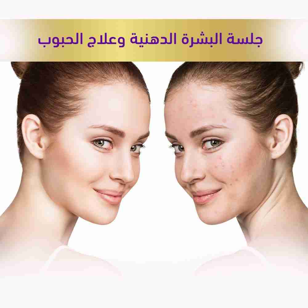 جلسه-البشره-الدهنيه-وعلاج-الحبوب