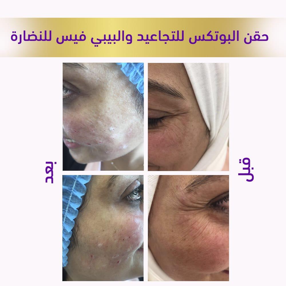 حقن البوتكس للتجاعيد والبيبي فيس للنضارة