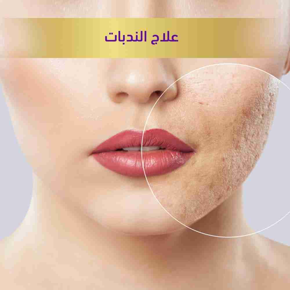 علاج-الندبات