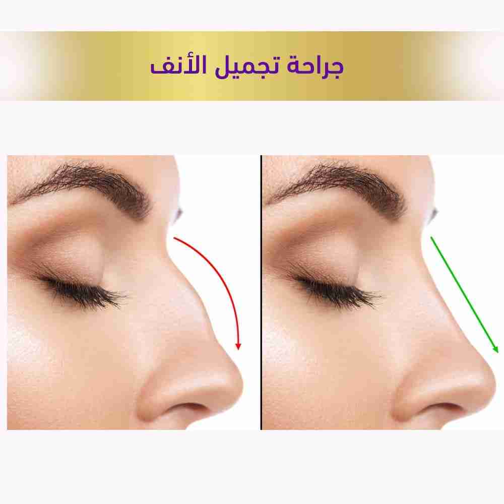جراحه تجميل الأنف