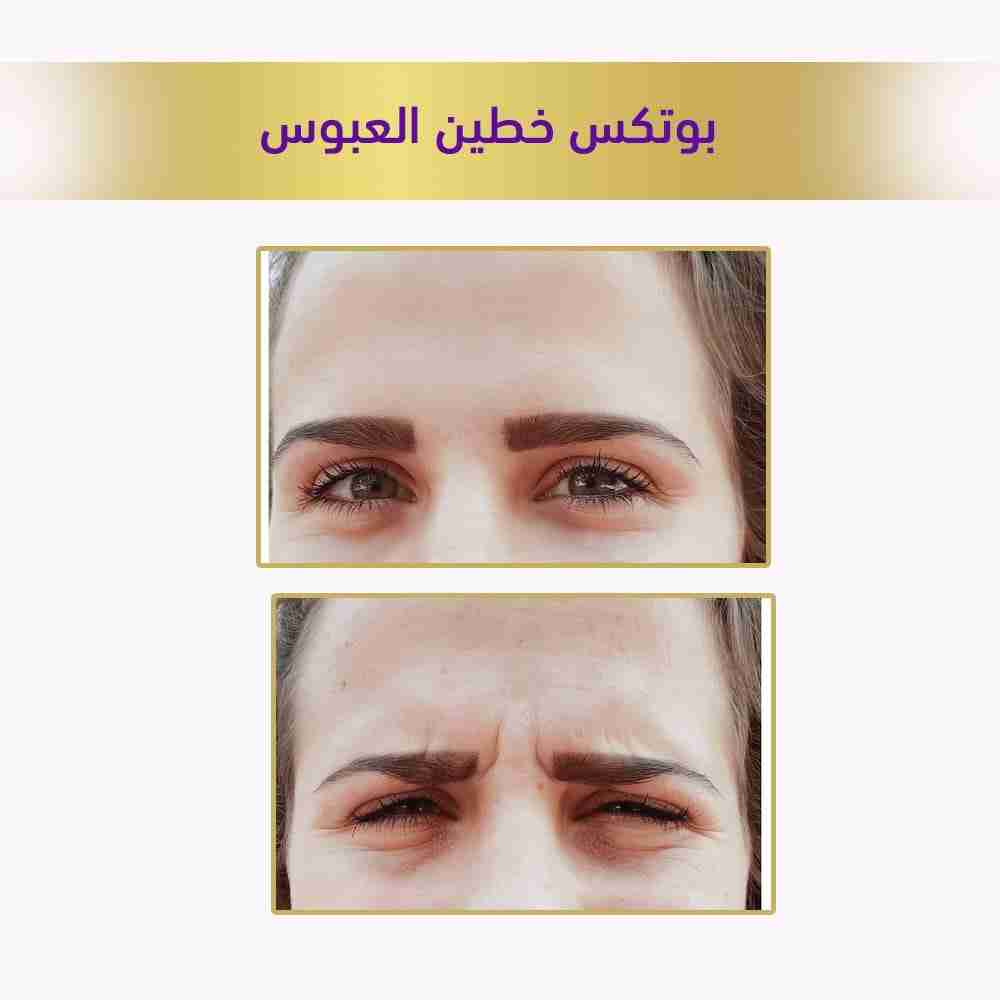 بوتكس خطين العبوس