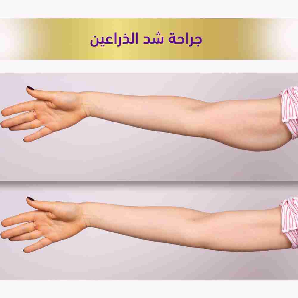 جراحه شد الذراعين