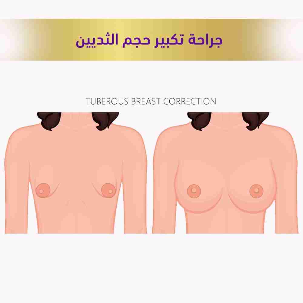 جراحه تكبير حجم الثديين