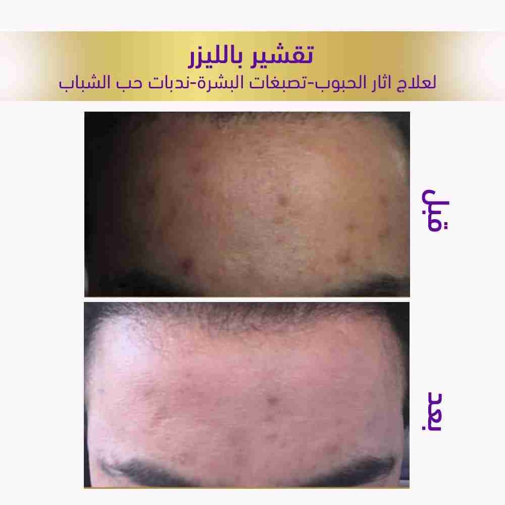 تقشير الليزر