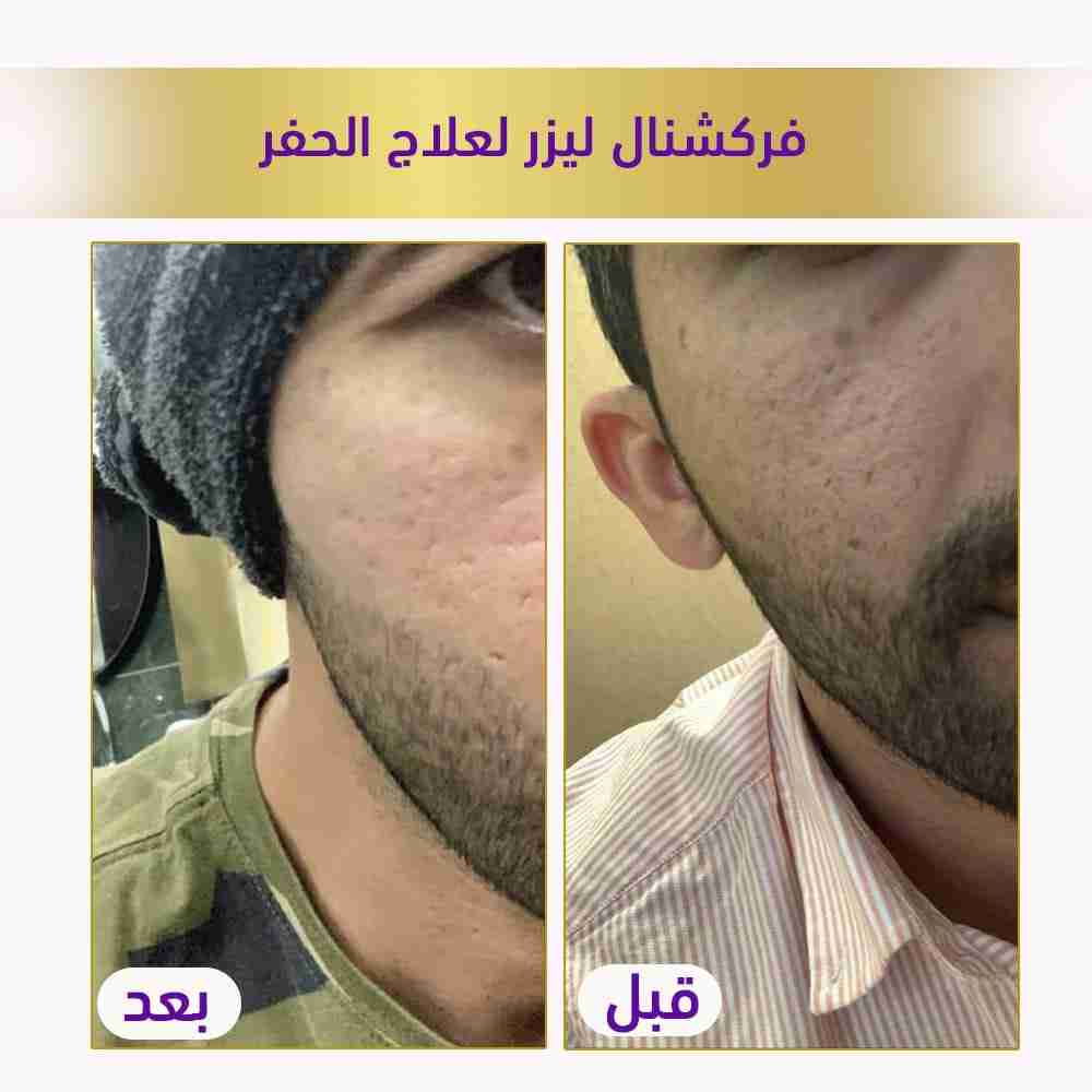 فركشنال ليزر لعلاج الحفر