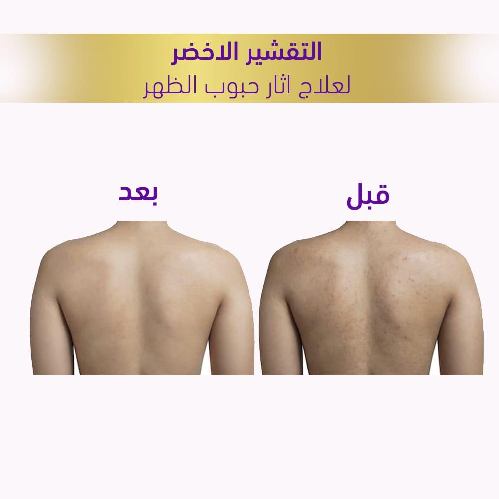 التقشير الاخضر لعلاج اثار حبوب الظهر