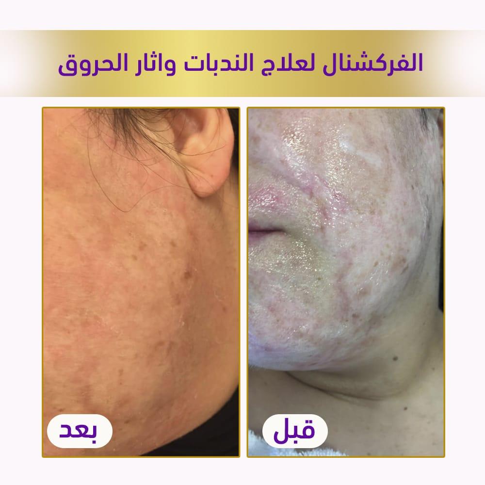 فركشنال لعلاج اثار الحبوب