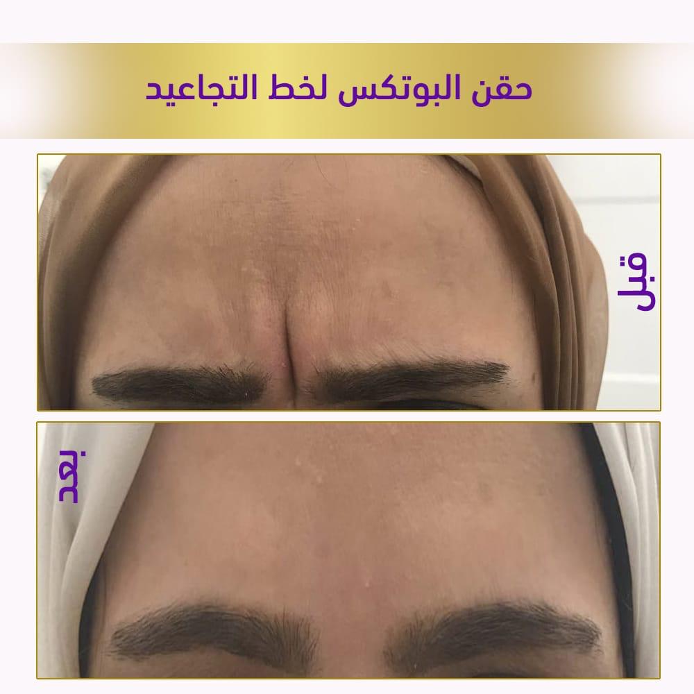 حقن البوتكس لخط التجاعيد