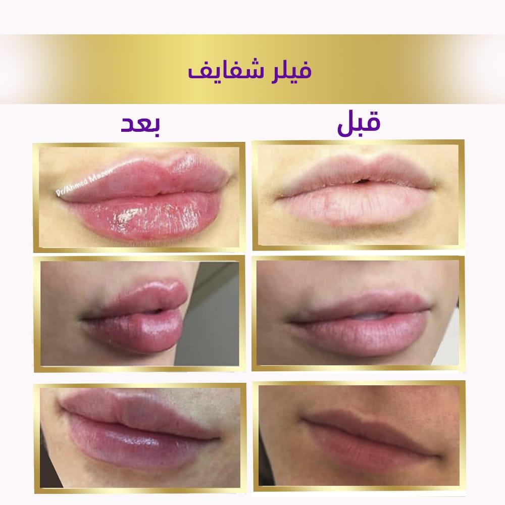 فيلر شفايف